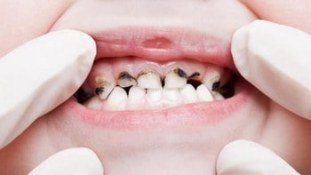 Чёрные зубы: почему они темнеют и как с этим бороться?