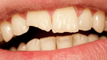 Какие виды сколов зубов бывают?