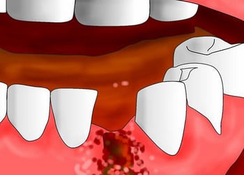 10 советов после удаления зубов