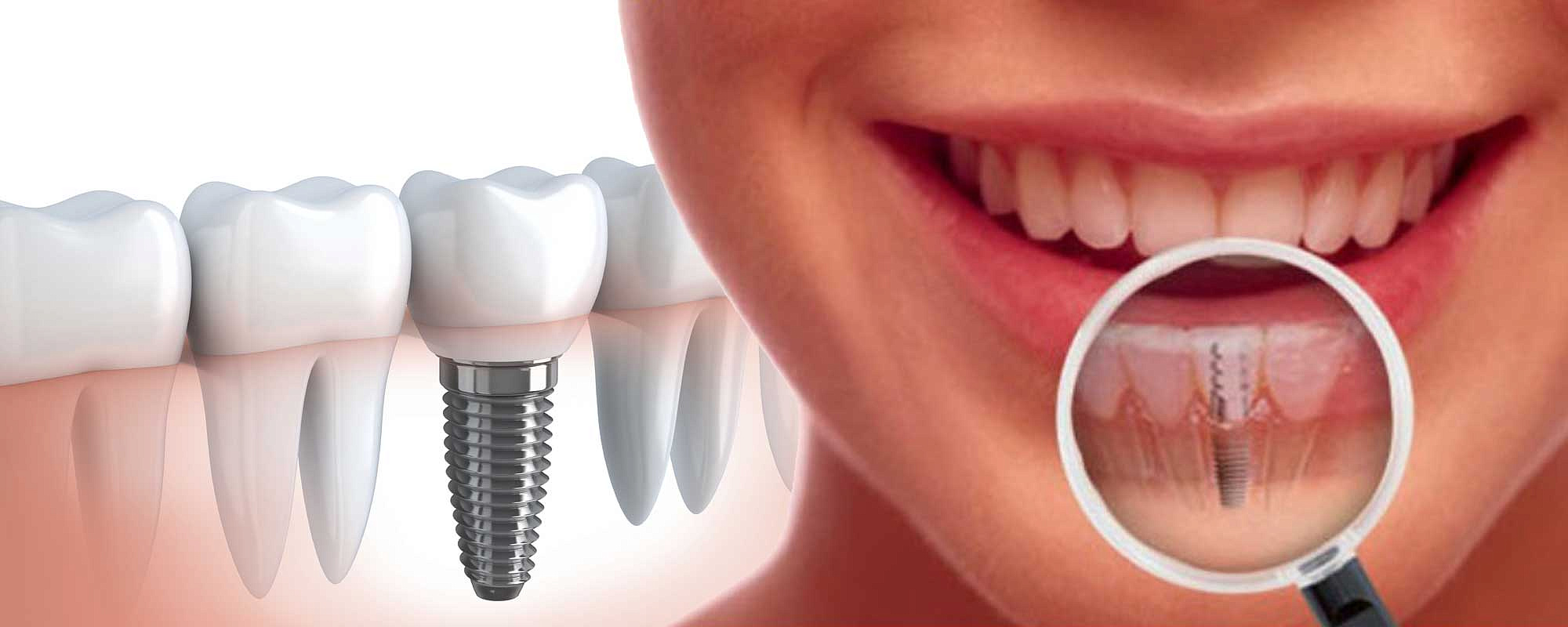 Имплантация зубов в СПб под ключ | Узнать цены на имплантацию зубов