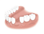 Отсутствие зубной единицы в любом участке челюсти